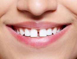 Gap Teeth