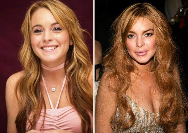Lindsay Lohan Before and After